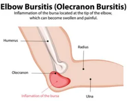 Elbow Bursitis