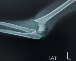 Elbow Fractures & Dislocations (1)
