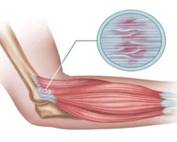 Elbow Tendonitis