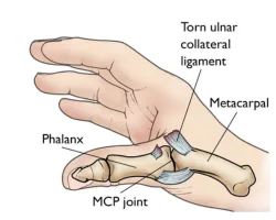 Ligament Injuries