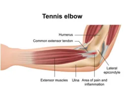 _Tennis Elbow (Lateral Epicondylitis)