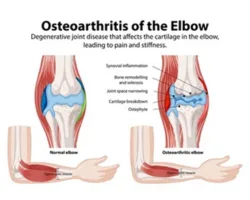 Osteoarthritis of the elbow Arthritis