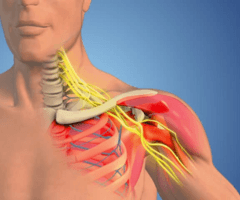 Nerve Damage and Brachial Plexus Injury
